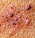 shingles rash on skin