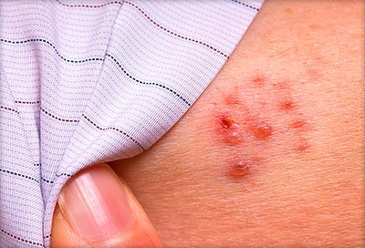 'My Experience with Shingles.' | NIH MedlinePlus the Magazine