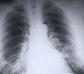 Findings suggest lung cancer develops through