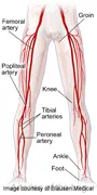 Researchers find tripled risk of leg blood clots,