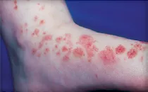 Red spot on my ankle. - Dermatology - MedHelp