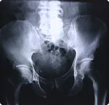 The Devastating Toll of Hip Fractures