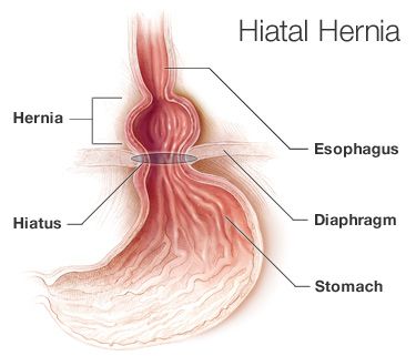 What foods should you avoid if you are diagnosed with a hiatal hernia?