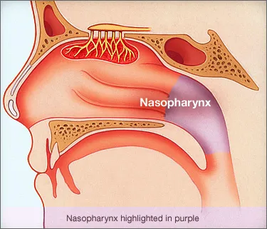 Image result for image of nasopharyngeal cancer