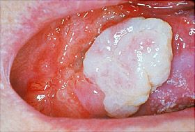 What is mouth cancer?