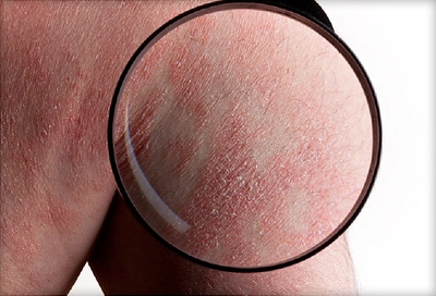 Dermatitis herpetiformis steroid treatment