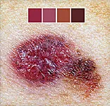 Top Story - Telltale Signs   of Skin Cancer