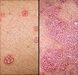 Psoriasis overview