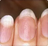 Top Story - What Your Nails   Reveal About Your Health