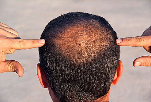 Почему у мужчин выпадают волосы на голове из-за болезней?