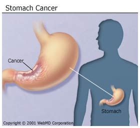 Carcinoma Of Stomach