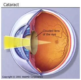 Diabetes Cataracts
