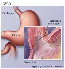 What are some symptoms of Barrett's esophagus?