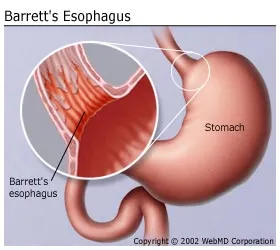 What are some symptoms of Barrett's esophagus?