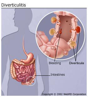 Causes Of Diverticular Disease In Men