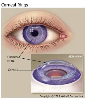 Stroma Eye