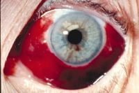 How long does it take an eye hemorrhage to heal?