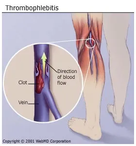 Treatment For Phlebitis Mayo Clinic