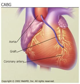 Bypass Surgery Heart