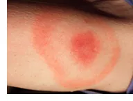 Picture of Lyme Disease