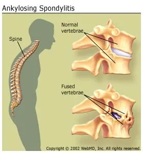 Ankylosing Spondylitis Pictures