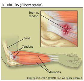 tendinitis: elbow strain