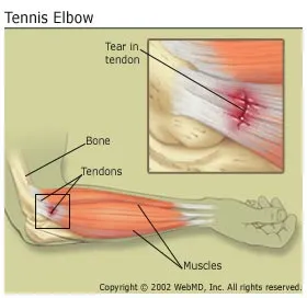 arthritis_tennis_elbow.jpg