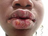 Herpes simplex virus: Type 1 and Type 2 Symptoms ...