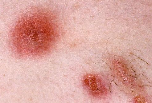 Where can you find pictures of MRSA skin infections?
