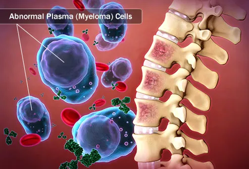 Illustration of multiple myeloma plasma cells