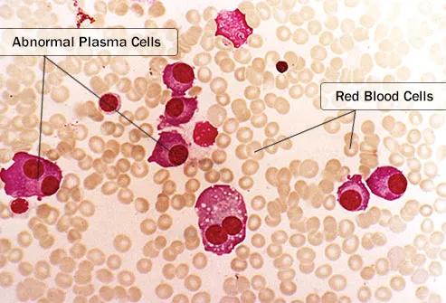 multiple myeloma in bone marrow