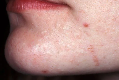 Close up of mild acne