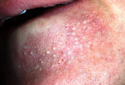 Close up of man with papules