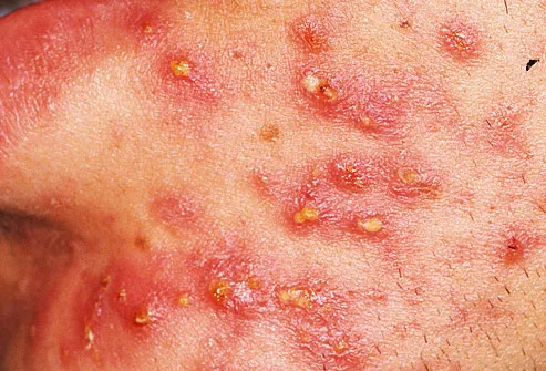 Close up of man with pustules