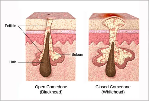 Diagram Of Hair And Skin. is a hair follicle that