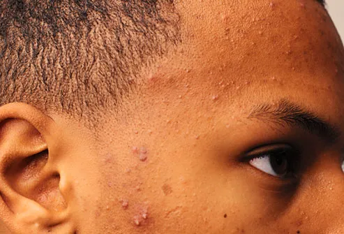 Close up of boy with moderate acne