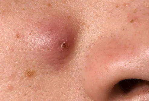 What causes numerous lumps under the skin?