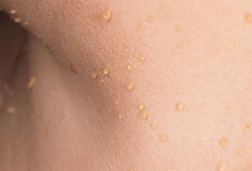 Photo of skin tags on a woman's neck