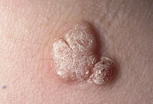 common warts on fingers. In most cases, warts are