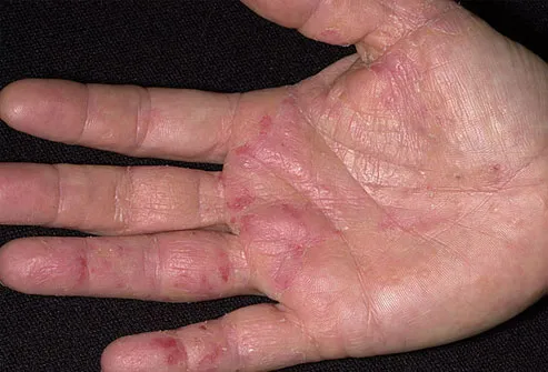 Eczema Outbreak on Hand