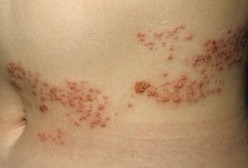 Shingles(Herpes Zoster)