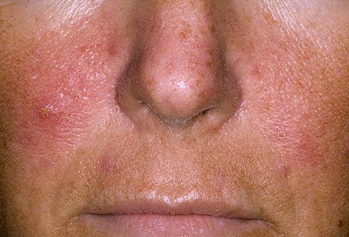 Skin Bumps On Face