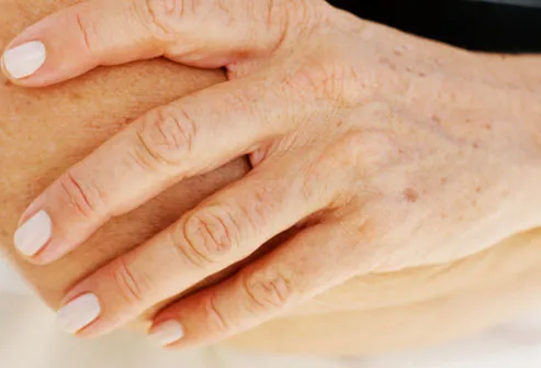 common warts on fingers. more common as people age.
