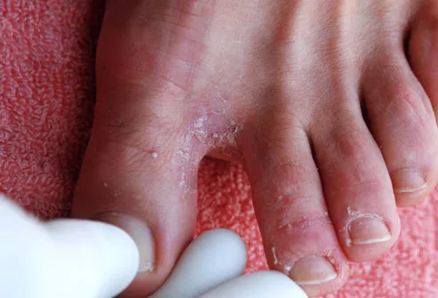 Foot Fungus Between Toes Symptoms