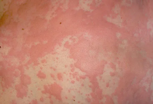 Photo of Hives (Urticaria)