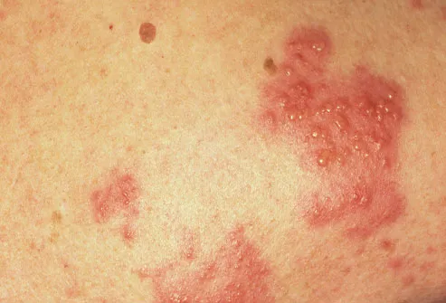 herpes pictures. Shingles (Herpes Zoster)