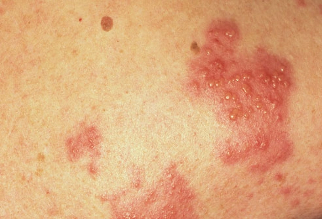 Life-Threatening Skin Rashes Causes ... - eMedicineHealth