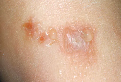 allergic reaction rash. Photo of poison ivy skin rash