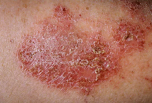 Itchy Eczema Patch on Skin