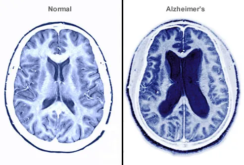 alzheimers brain